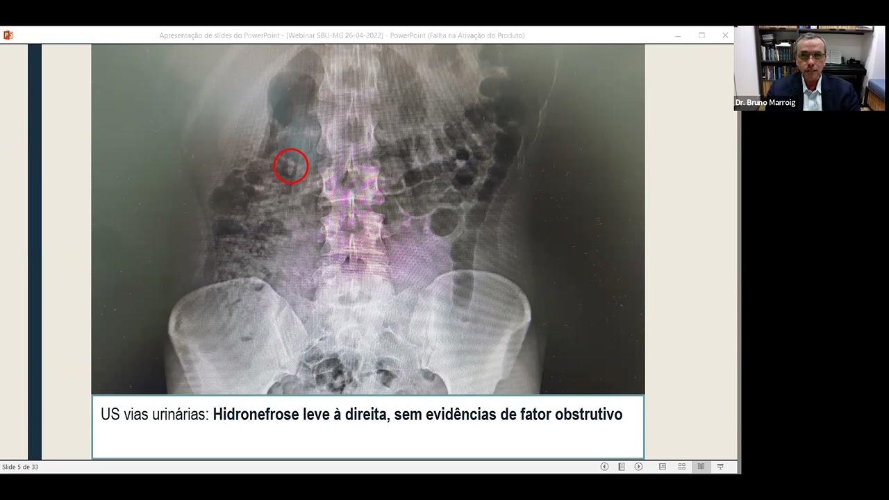 Ureterolitotripsia Flexível: Como Evitar Complicações e Como Sair de Situações Difíceis